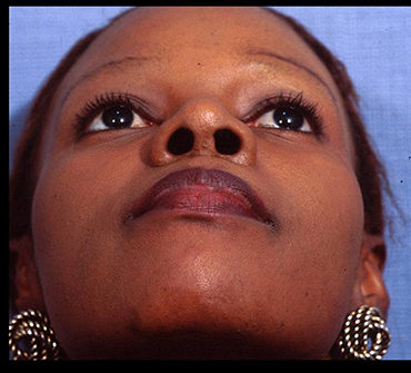 Rhinoplasty Before & After Patient #4445