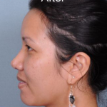 Rhinoplasty Before & After Patient #4444