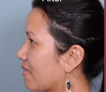 Rhinoplasty Before & After Patient #4444