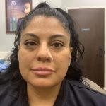 Dimple Creation Before & After Patient #3728