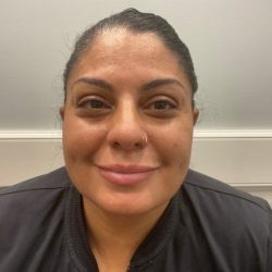 Dimple Creation Before & After Patient #3728