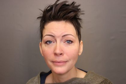 Chin Implants Before & After Patient #3704