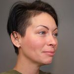Chin Implants Before & After Patient #3704