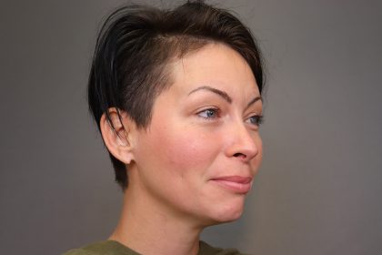 Chin Implants Before & After Patient #3704