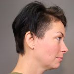Chin Implants Before & After Patient #3704