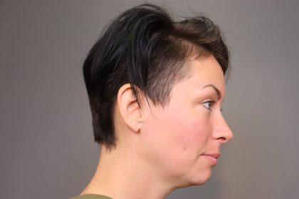 Chin Implants Before & After Patient #3704