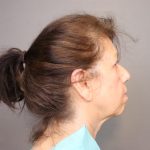 Chin Implants Before & After Patient #3705