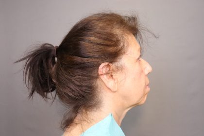 Chin Implants Before & After Patient #3705