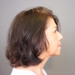 Chin Implants Before & After Patient #3705