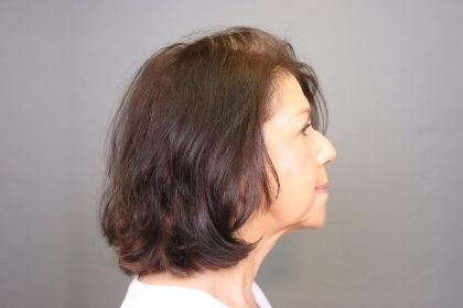 Chin Implants Before & After Patient #3705