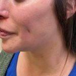 Dimple Creation Before & After Patient #3729