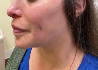 Dimple Creation Before & After Patient #3729