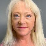 Blepharoplasty Before & After Patient #4450