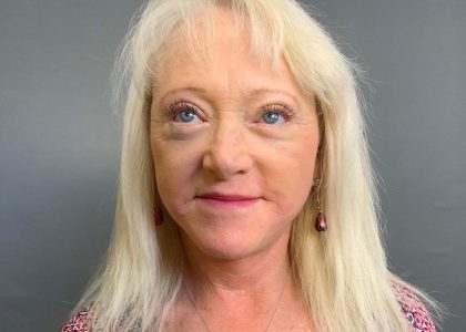 Blepharoplasty Before & After Patient #4450