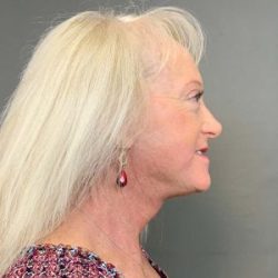 Blepharoplasty Before & After Patient #4450