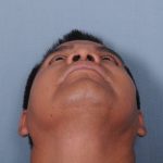 Rhinoplasty Before & After Patient #3637