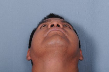 Rhinoplasty Before & After Patient #3637