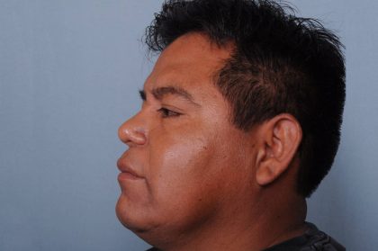 Rhinoplasty Before & After Patient #3637