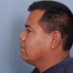 Rhinoplasty Before & After Patient #3637