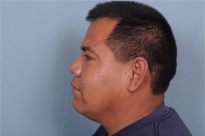 Rhinoplasty Before & After Patient #3637