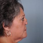 Reconstruction Before & After Patient #3690