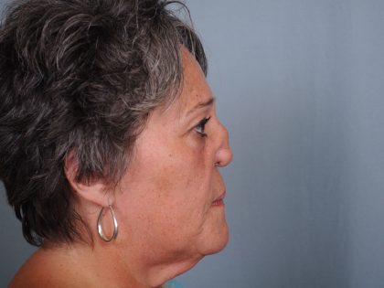 Reconstruction Before & After Patient #3690