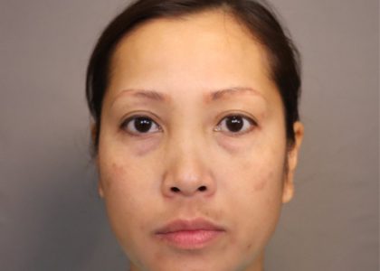 Blepharoplasty Before & After Patient #3595