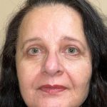 Blepharoplasty Before & After Patient #4521
