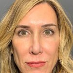 Blepharoplasty Before & After Patient #4522