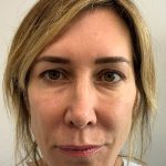 Blepharoplasty Before & After Patient #4522