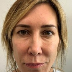 Blepharoplasty Before & After Patient #4522