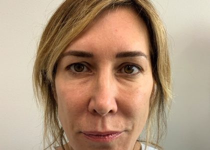 Blepharoplasty Before & After Patient #4522