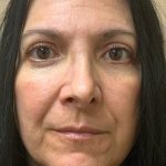 Blepharoplasty Before & After Patient #4538
