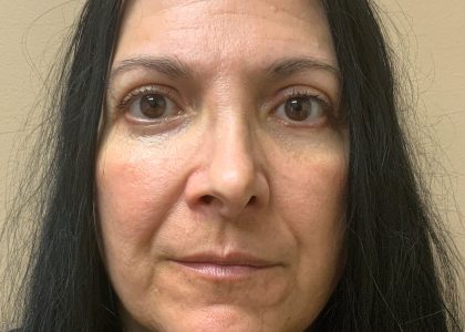 Blepharoplasty Before & After Patient #4538