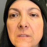 Blepharoplasty Before & After Patient #4538