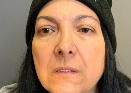 Blepharoplasty Before & After Patient #4538