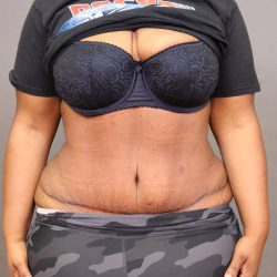 Abdominoplasty Before & After Patient #4139
