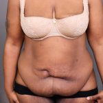 Abdominoplasty Before & After Patient #4139