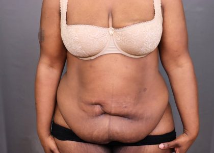 Abdominoplasty Before & After Patient #4139