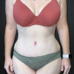 Abdominoplasty Before & After Patient #4140