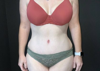 Abdominoplasty Before & After Patient #4140