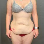 Abdominoplasty Before & After Patient #4140
