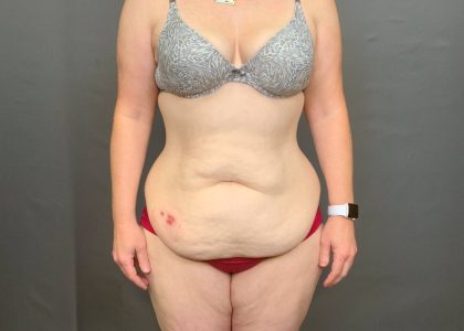 Abdominoplasty Before & After Patient #4140