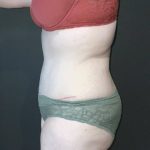 Abdominoplasty Before & After Patient #4140