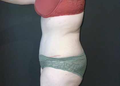 Abdominoplasty Before & After Patient #4140