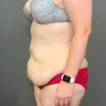 Abdominoplasty Before & After Patient #4140