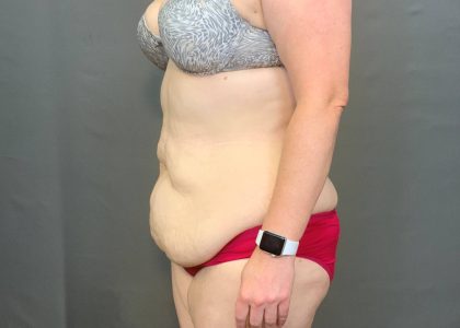 Abdominoplasty Before & After Patient #4140