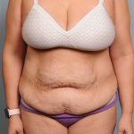 Abdominoplasty Before & After Patient #4116