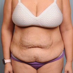 Abdominoplasty Before & After Patient #4116