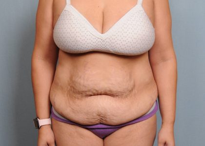 Abdominoplasty Before & After Patient #4116